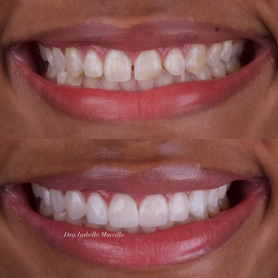 Reconstrução Estética (antes e depois)